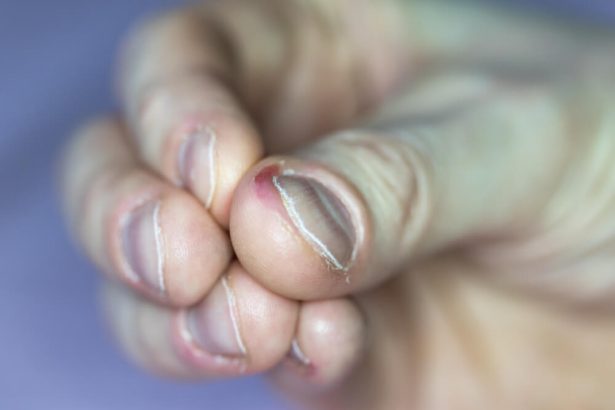 Comment Arrêter De Se Ronger Les Ongles