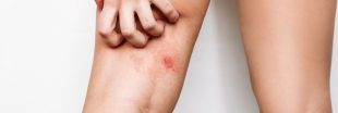 Piqûres de moustiques : démangeaison ou réelle allergie, mieux vaut savoir faire la différence