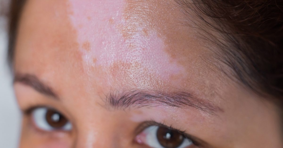 Vitiligo : un premier traitement contre cette maladie de la peau est disponible en pharmacie
